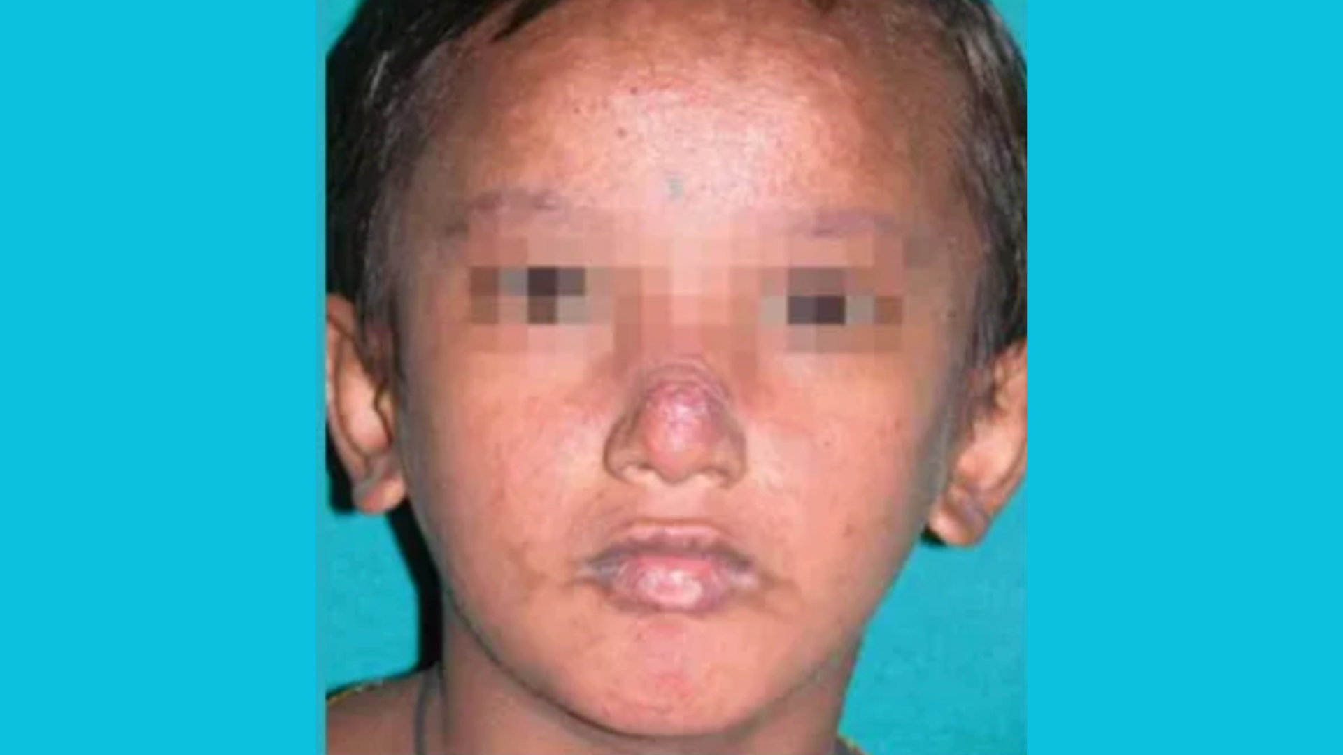 Post-kala-azar dermal leishmaniasis: training of health workers on skin-NTDs H0033EN